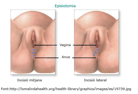 Episiotomia; Incisió mitjana i incisió lateral